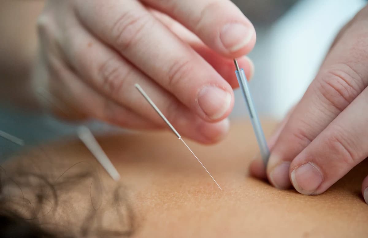 Acupunctuur behandeling met naalden